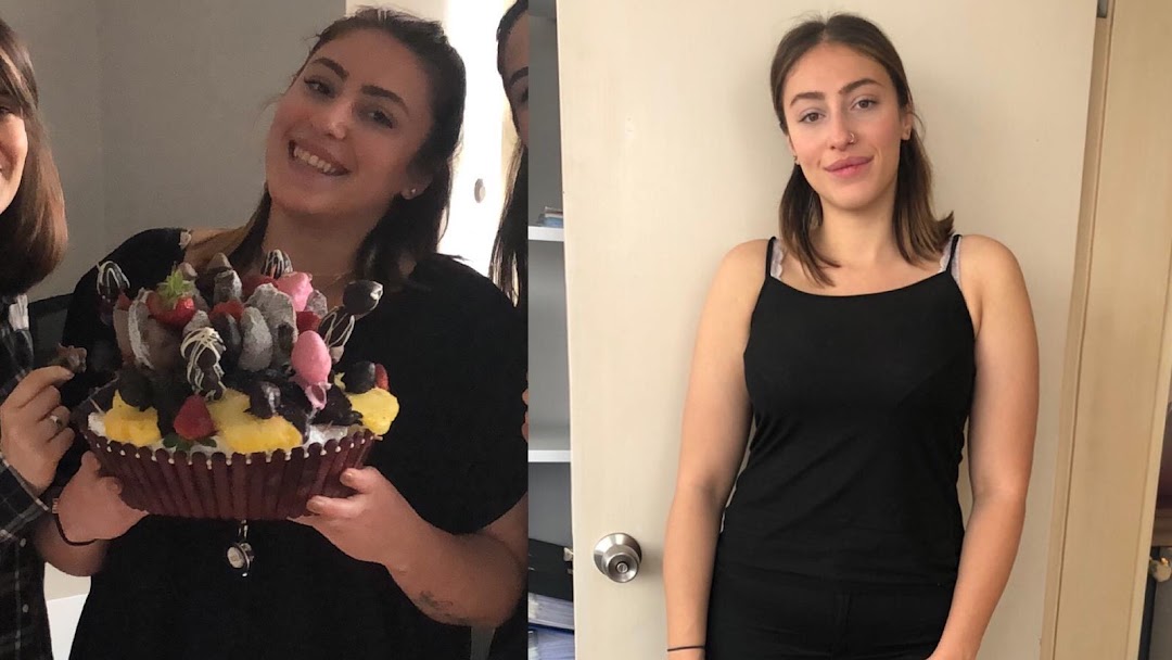 Akupunktur ile Zayıflama