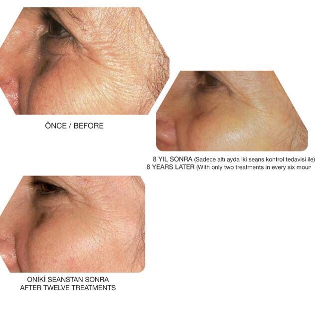 Ankara Akupunktur ve Mezoterapi