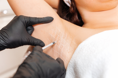 terleme botoksu tedavisi